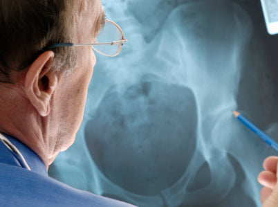 Wechseljahresbeschwerden: Osteoporose
